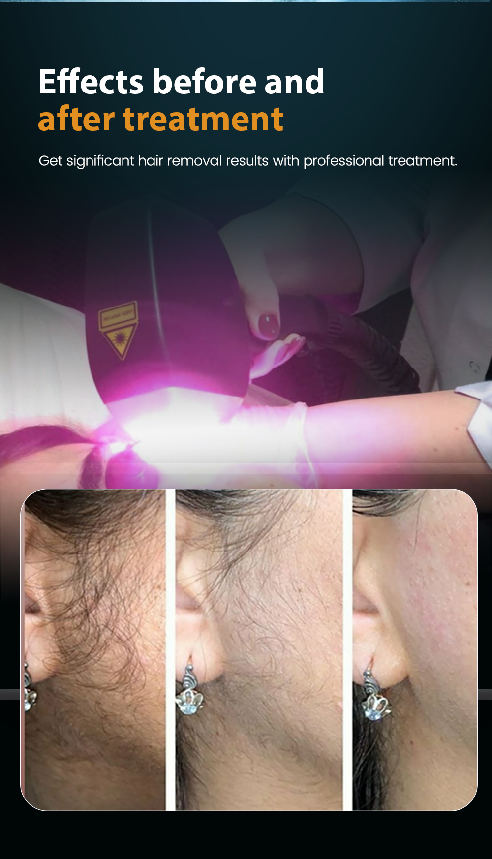 MDR HOT hair removal laser