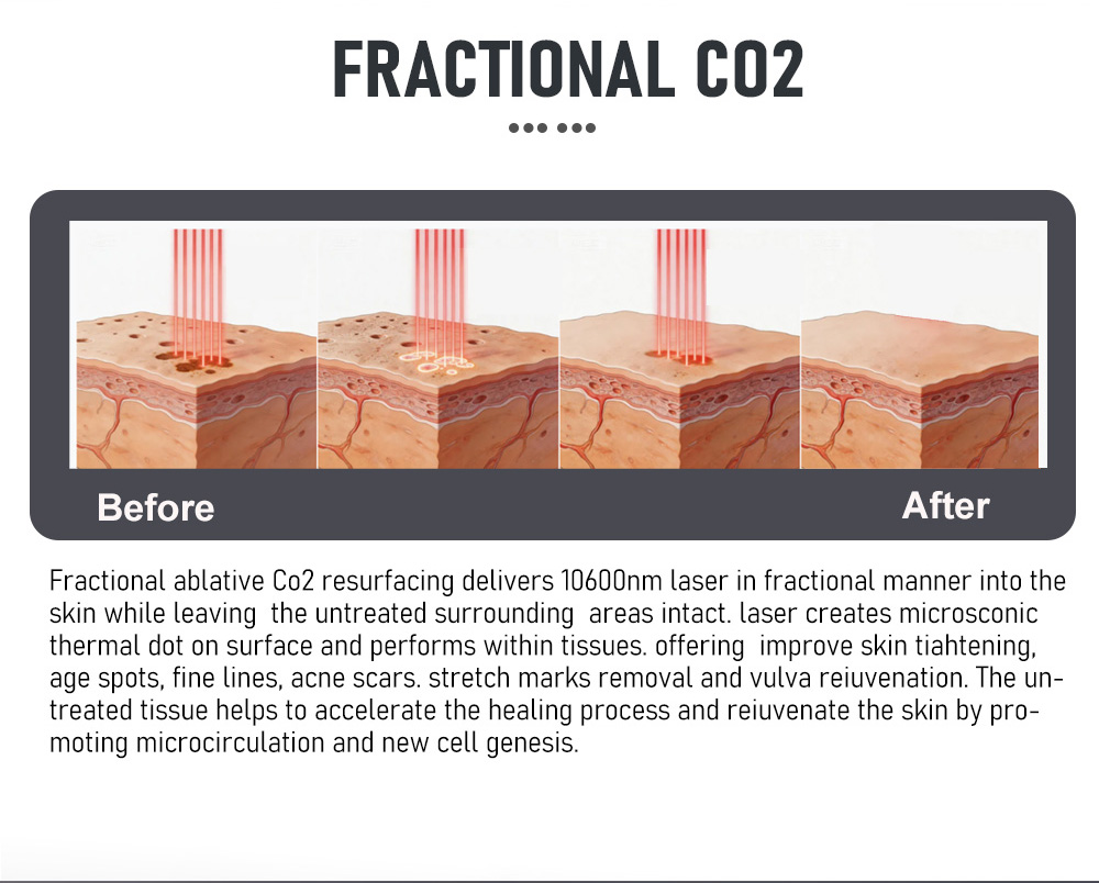 MDR HOT selling CO2 laser